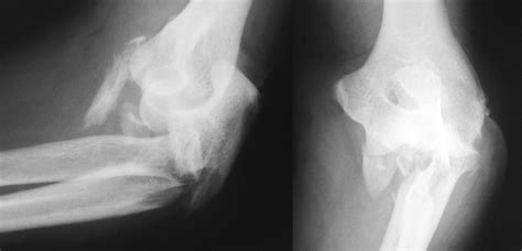 Monteggia Fractures In Adults Bone And Joint