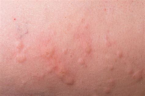 Common Skin Conditions Nhsuk