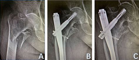 Frontiers When To Reduce And Fix Displaced Lesser Trochanter In