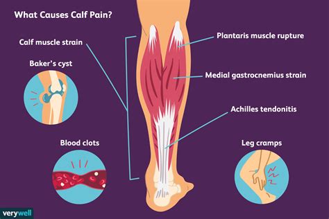 Leg Pain Calf Muscle