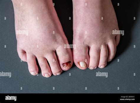 Patient After A Few Days Of Healing Showing Toe With One Toenail