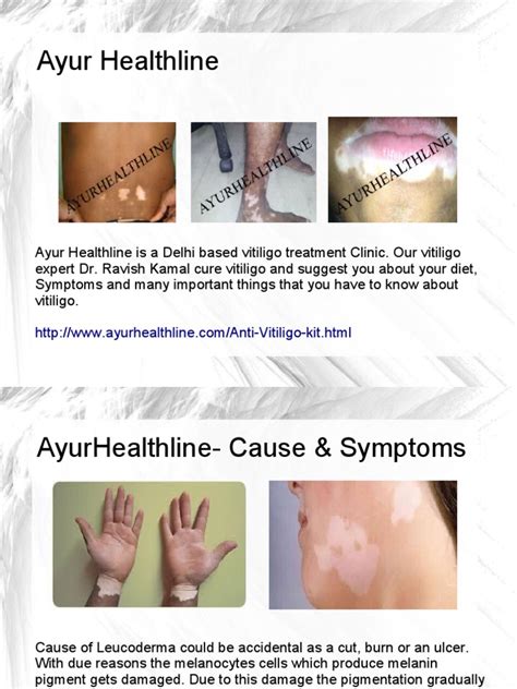 Ayurhealthline Vitiligo Cure Experts‎