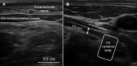 The Ultrasound Images Of The Great Auricular Nerve A And The Measured