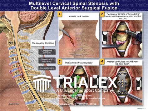 Multilevel Cervical Spinal Stenosis Wit Double Level Anterior Surgical
