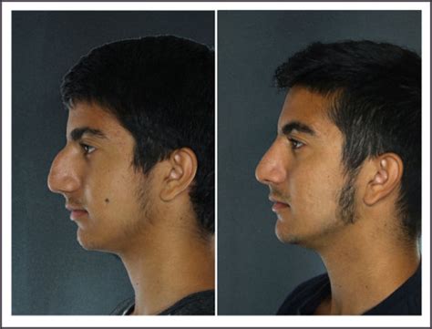 How To Get The Perfect Nose Medcare Spainmedcare Spain