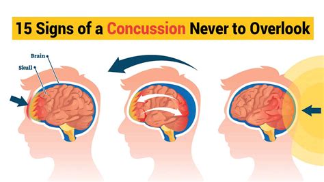 15 Signs Of A Concussion Never To Overlook 6 Minute Read