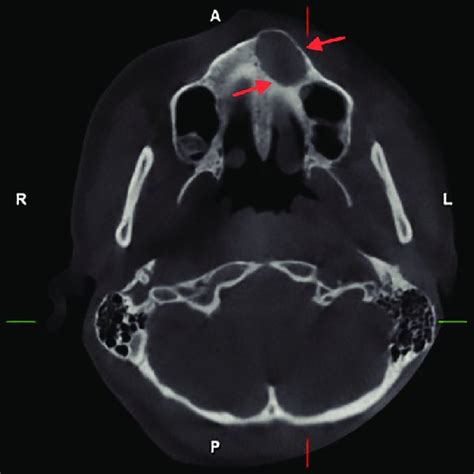 Axial Cbct Images Showing Dentigerous Cyst In The Maxilla Download