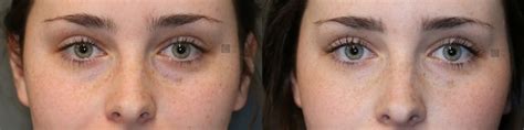 Patient 41311283 Wrinkle Relaxer Before And After Clinic 5c