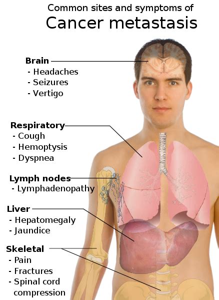 The early signs and symptoms of lung cancer may be typical (persistent cough, shortness of breath, or coughing up blood) or less anyone can get lung cancer, and without a screening test for everyone, an awareness of these symptoms is important in detecting the disease as early as possible. File:Symptoms of cancer metastasis.svg - New World ...
