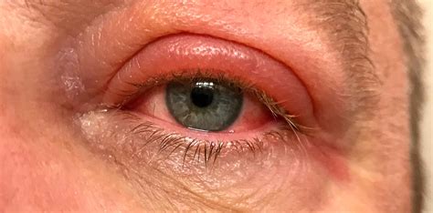 Pus Filled Lesion On The Eyelid Resulting From An Infection