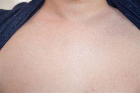 Red Bumps On Chest