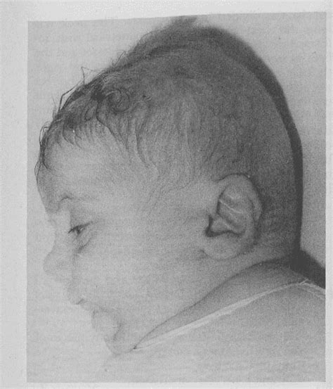 Figure From Trisomy Mosaicism Syndrome Semantic Scholar