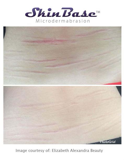 Microdermabrasion Results From Face And Body Treatments