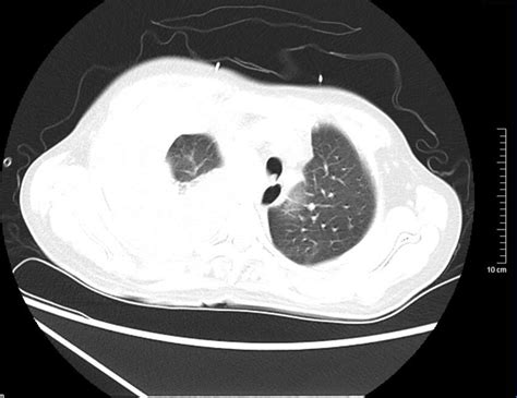 The Chest Ct Scan Showed A Massive Pleural Effusion On The Right Side