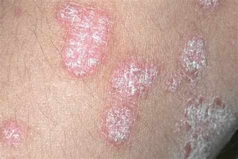 10 Rashes That Could Reveal A Dermatologic Disease