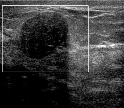 Cystic Masses Of The Breast Ajr