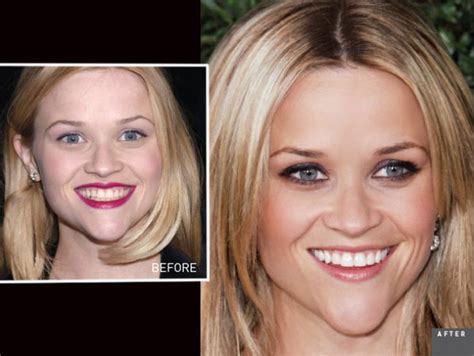 Pin By Baseline Dental Practice On Interesting Celebrity Smiles In Smile Makeover