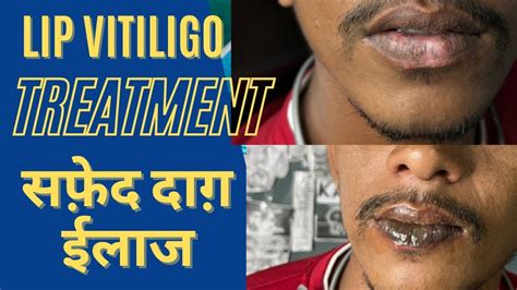 The Best Lip Vitiligo Treatment Lip Vitiligo Treatment India White