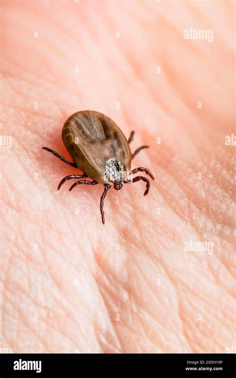 Encephalitis Infected Tick Insect Crawling On Skin Lyme Borreliosis