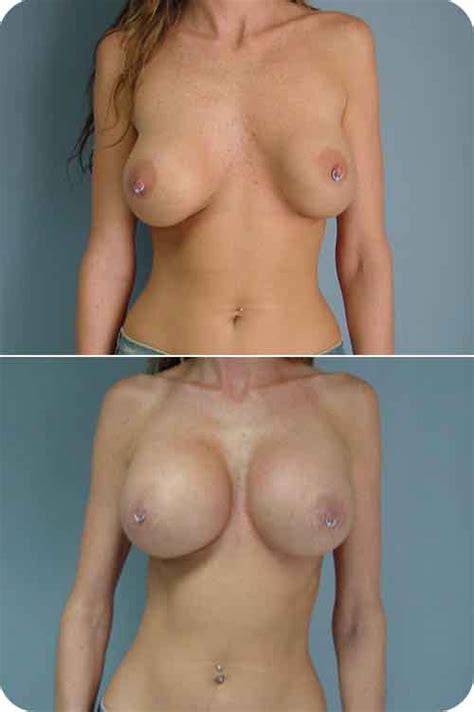 Reconstructive Tits - Partial Breast Reconstruction Techniques In OncoplasticSexiezPix Web Porn
