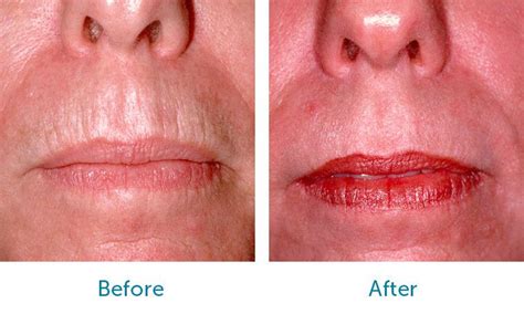 Face Sydney Cosmetic Clinic Laser Skin Resurfacing Laser