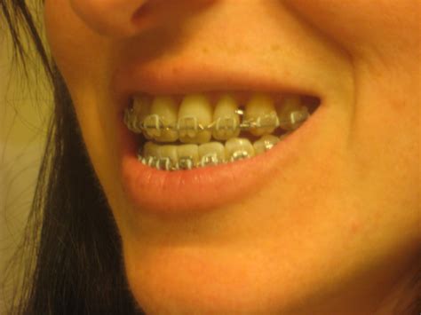 Sarpe Jaw Surgery And Adult Braces Oh My Lower Surgery Date