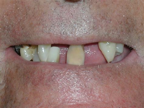 Immediate Denture Before And After Pictures Dr Caputo Palm Harbor