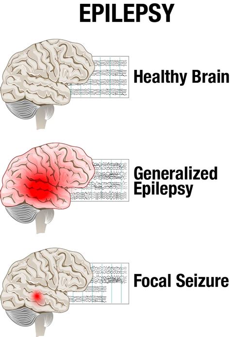 Webmd explains the causes of epilepsy and what can trigger seizures. Neurosciences - Epilepsy & Seizures