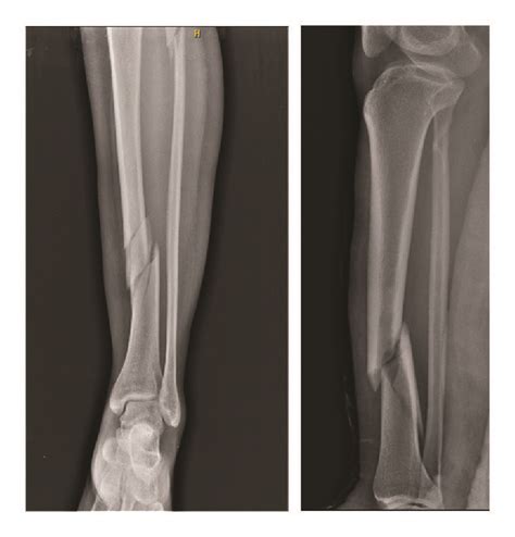 Radiographs Showing The Anteroposterior And Lateral Views Of Tibial