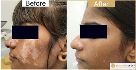 Drrachis Skin City Vitiligo Treatment White Spot Treatment