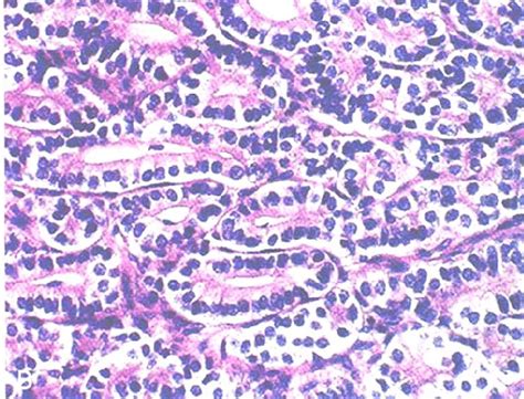 Pathology Of Sertoli Leydig Cell Tumor There Are Solid Tumors With