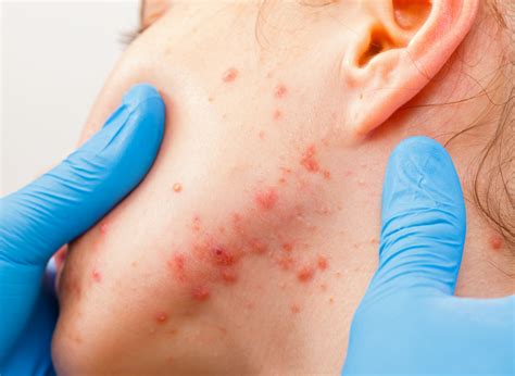 Iv type of allergic reaction part i. Elimination diet for skin allergies