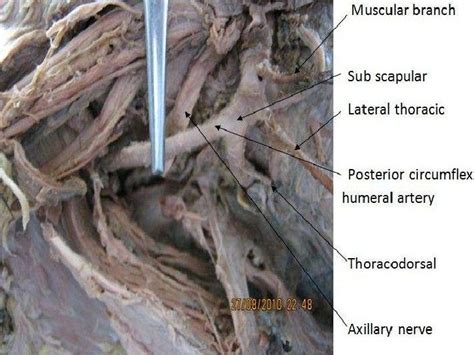 Abnormal Branching Pattern Of The Axillary Artery