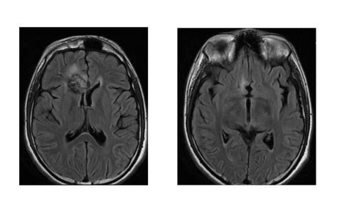 Cureus A Case Of Non Germinomatous Germ Cell Tumors Of The Frontal