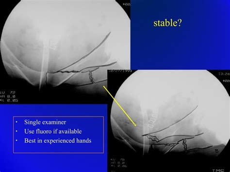 Trauma Pelvic Fracture Ortho Prespective Ppt Free Download