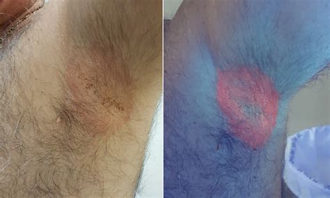 Corynebacterium minutissimum infection: erythrasma | The Medical