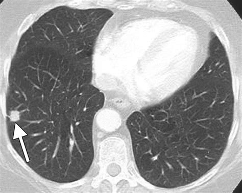 My 2 Cents Annual Lung Ct Scans For Smokers Good Or Bad
