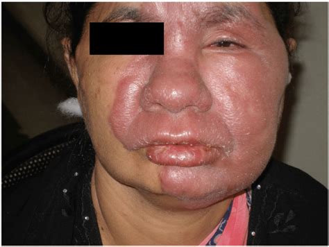 Patient With Borderline Tuberculoid Leprosy Face Lesion With Severe