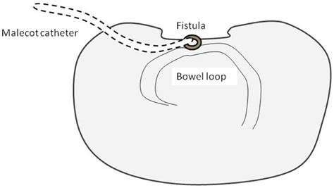 Enteroatmospheric Fistulae —gastrointestinal Openings In The Open