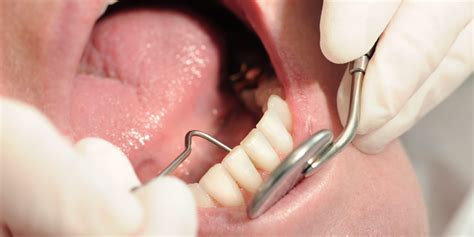 Zahnfleischr Ckgang Ursachen Und Therapie Heilpraxis