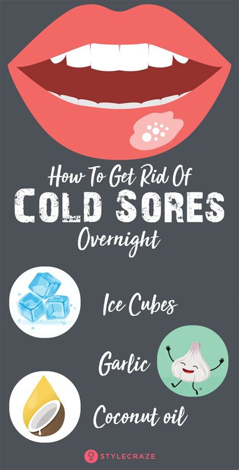 20 Home Remedies To Get Rid Of Cold Sores And Prevention Tips Artofit