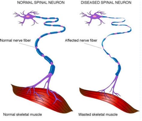 Amyothropic Lateral Sclerosis Nerve Cells
