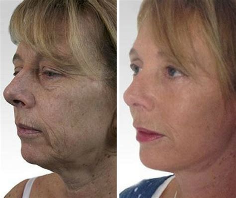 Best Treatment For Non Surgical Facelift What Are The Best