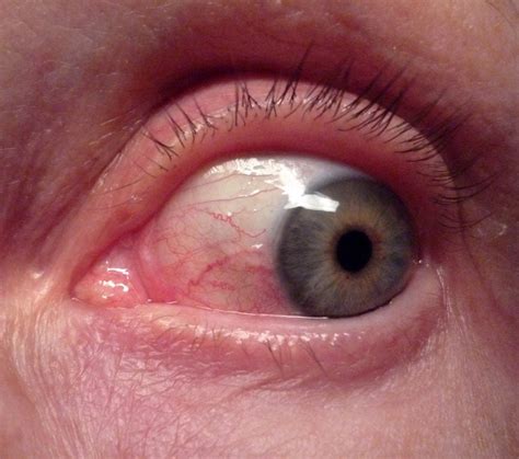 Red Spots In Eyes Causes And Treatment Smile Delivery