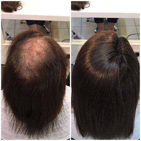Crown Volumiser Hair Loss Specialists Edinburgh