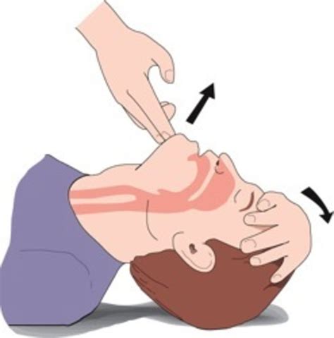First Aid Procedure For Artificial Respiration Mouth To Mouth And