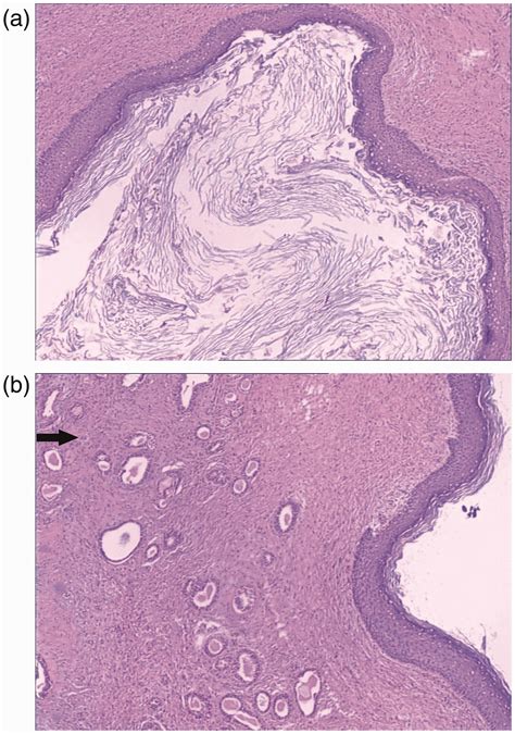 Giant Epidermal Inclusion Cyst With Infection Arising Within The Breast