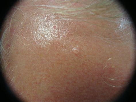 Sebaceous hyperplasia (sh) is inflammation and multiplication of cells inside the oil glands. Sebaceous Gland Hyperplasia (Sebaceous Hyperplasia, Senile ...