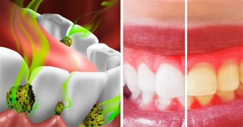 14 Ways To Reduce Bacteria In Your Mouth And