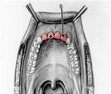 Anatomy Mouth Salivary Glands Flashcards Quizlet